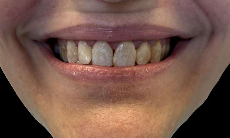 Esthetic-Resin-Bonding-Makeover-After-Image