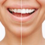 composite bonding vs dental veneers
