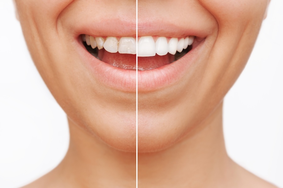 composite bonding vs dental veneers