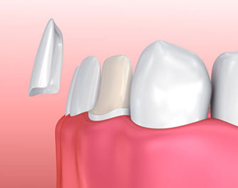 illustration of veneers