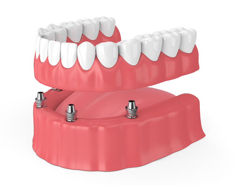 illustration of dental implants