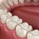 dental sealants prevent cavities, dental sealants vs. fluoride treatment