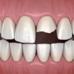 broken tooth after dental trauma, repair broken tooth