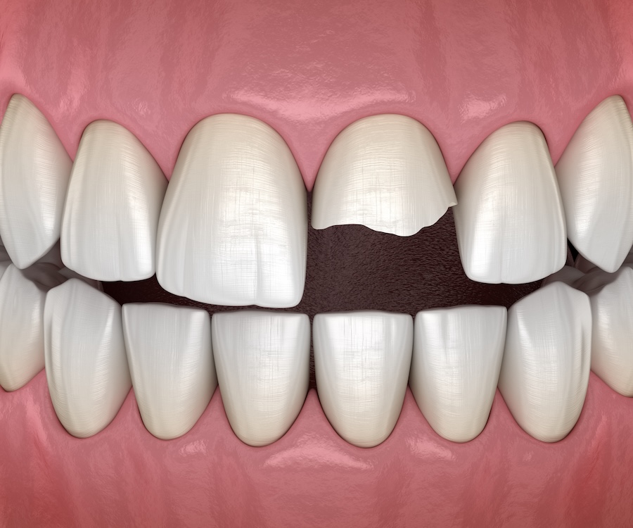 broken tooth after dental trauma, repair broken tooth