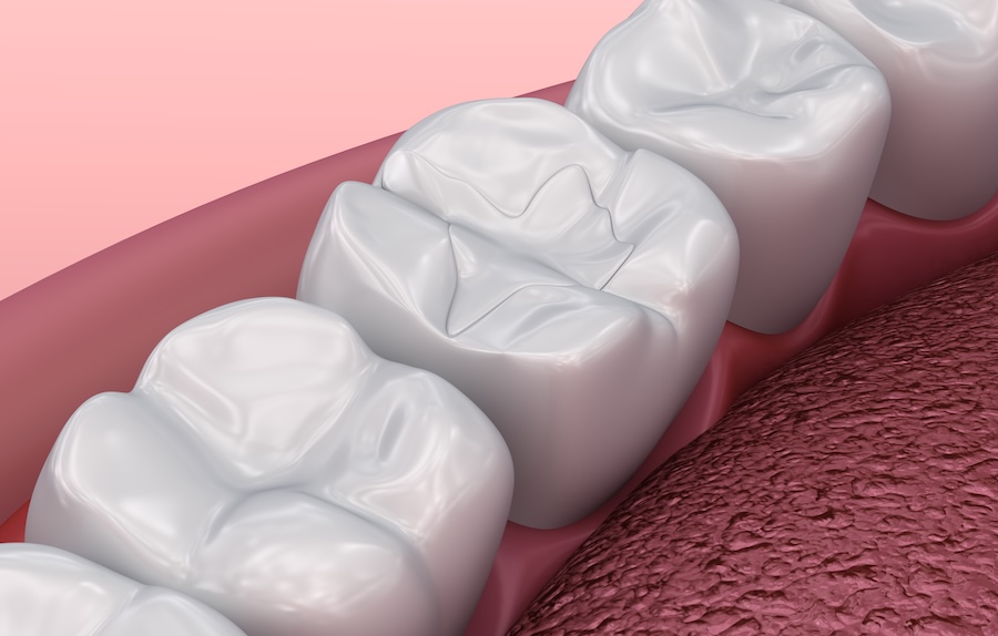 tooth colored fillings