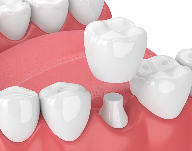 illustration of a dental crown