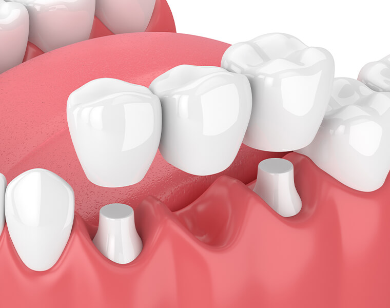 illustration of a dental bridge