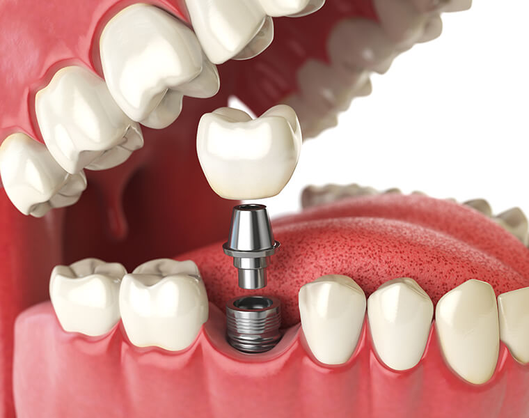 illustration of a dental implant