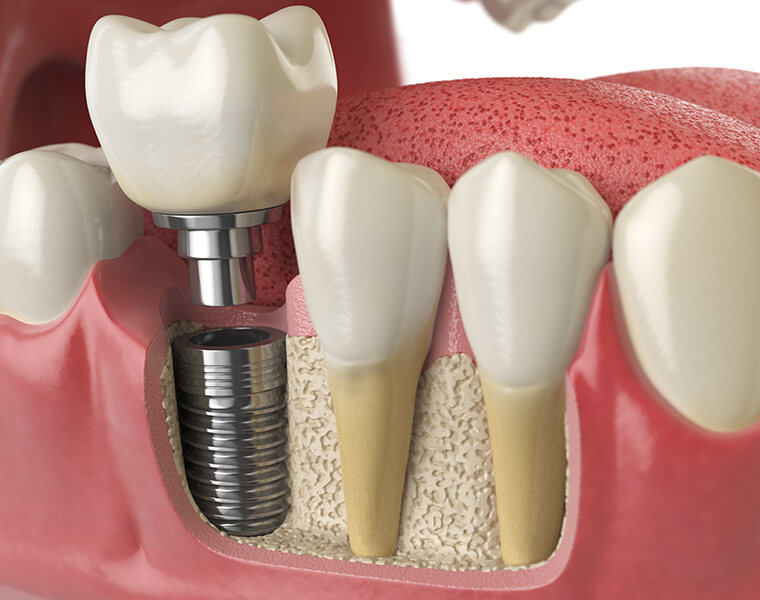 illustration of a dental implant